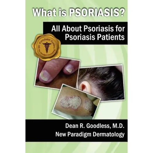 What is Psoriasis?: All About Psoriasis for Psoriasis Patients - Paperback
