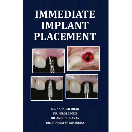 Immediate Implant Placement - Paperback