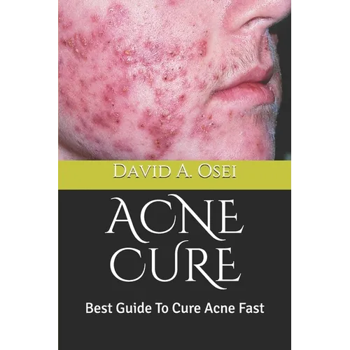 Acne Cure: Best Guide To Cure Acne Fast - Paperback