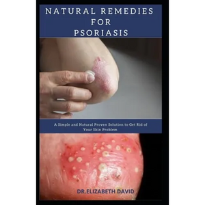 Natural Remedies for Psoriasis: A Simple and Natural Proven Solution to Get Rid of Your Skin Problem: Dermatitis, Eczema, Psoriasis & Rosacea and Othe - Paperback
