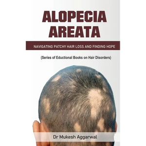 Alopecia Areata - Paperback