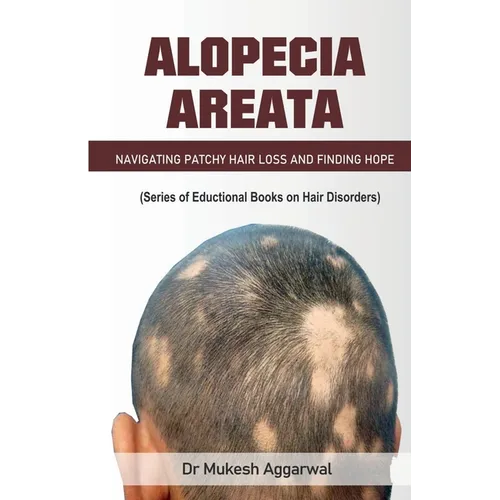 Alopecia Areata - Paperback